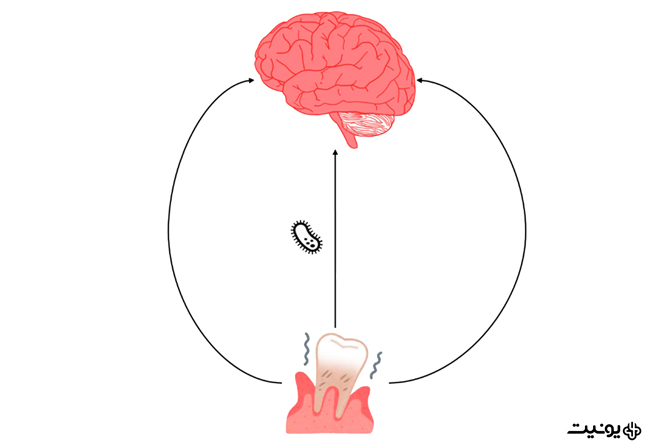آیا بیماری لثه می تواند باعث آلزایمر شود؟