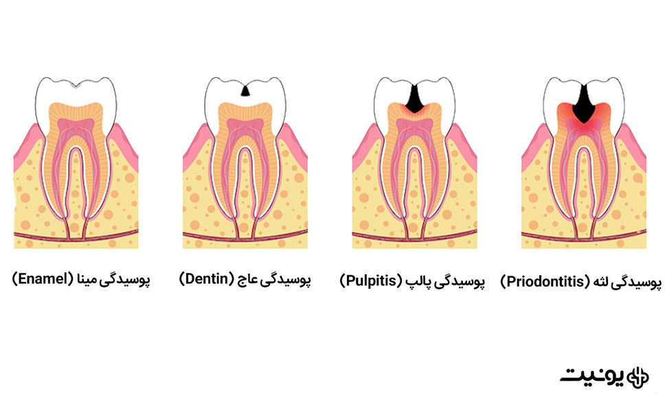 پوسیدگی دندان