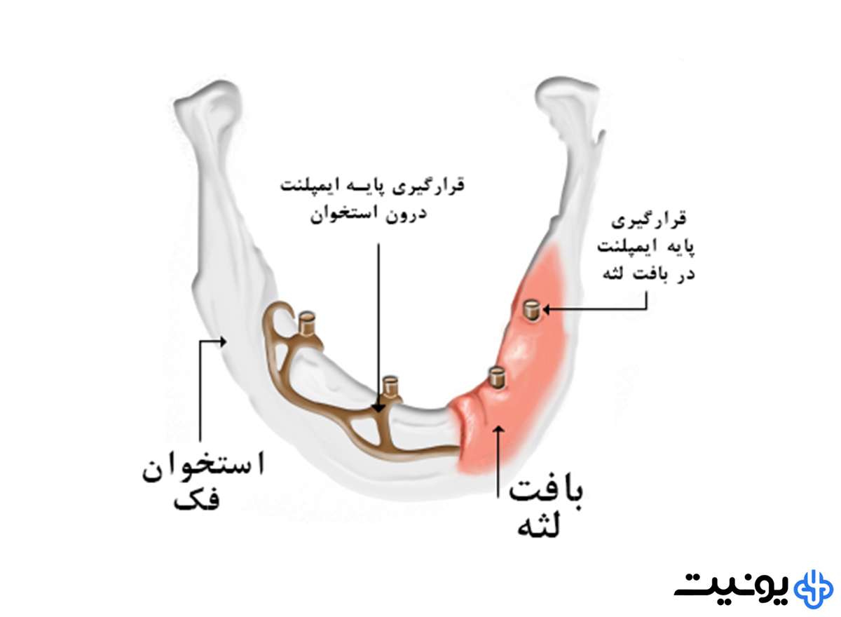 انواع مختلف ایمپلنت دندان