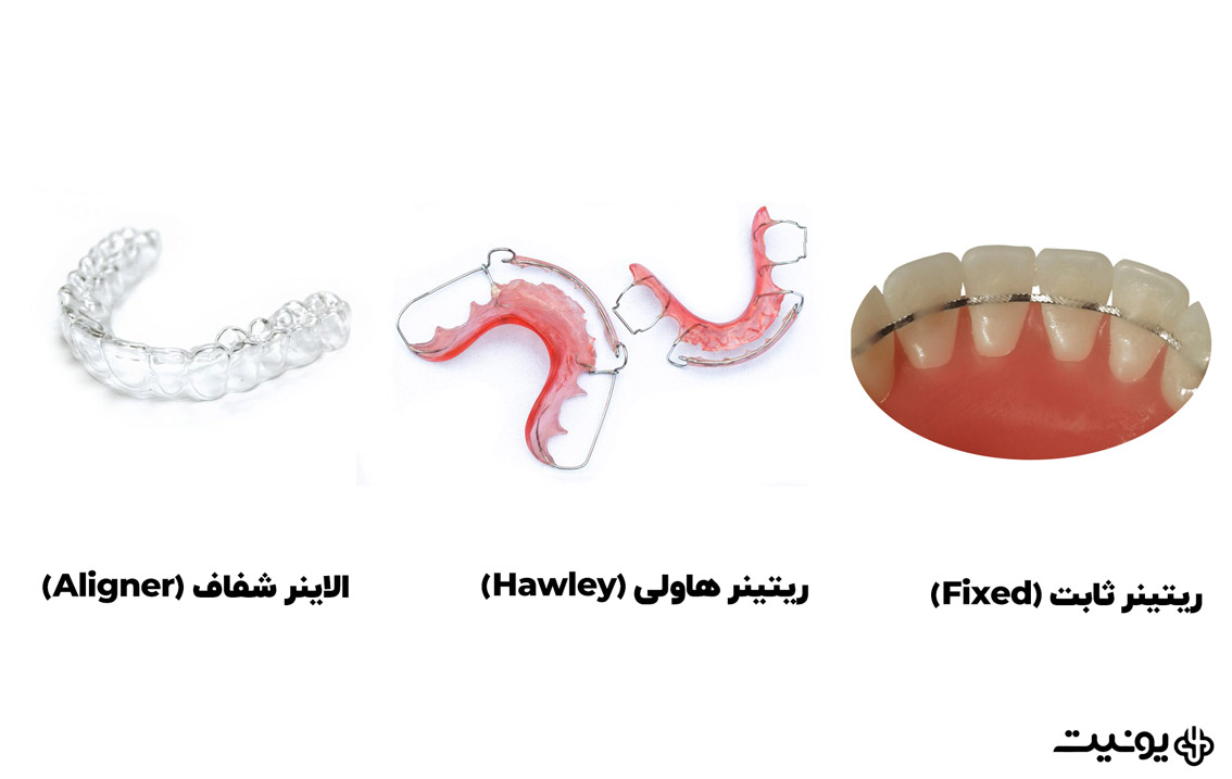 انواع ریتینرهای ارتودنسی متحرک