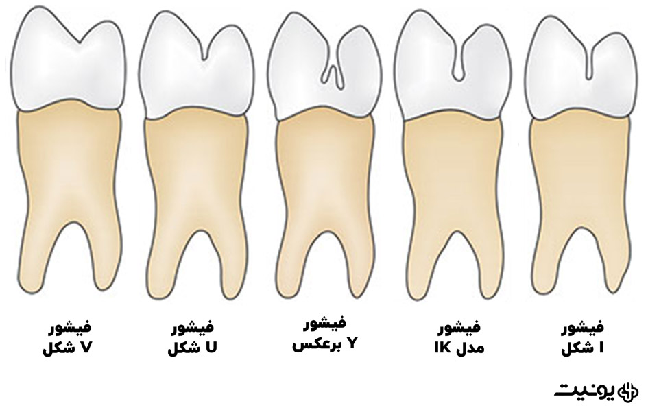 آشنایی با انواع فیشور (Fissure) دندان