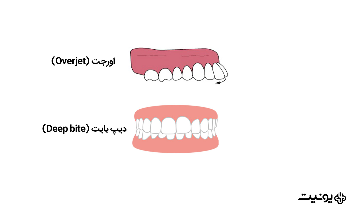 مال اکلوژن کلاس 2 و انواع آن