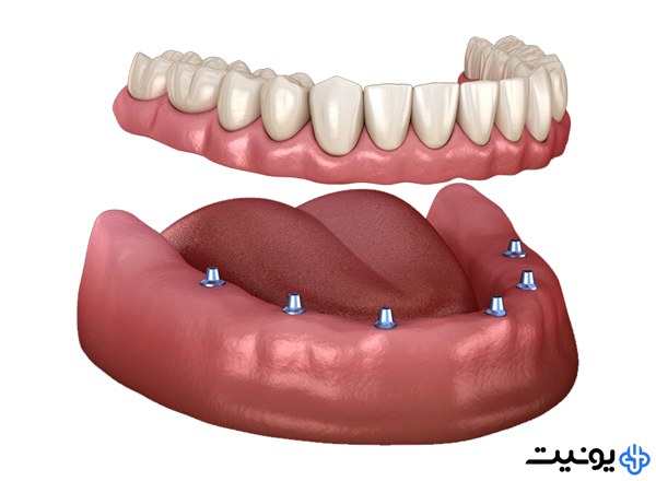 ایمپلنت اوردنچر چیست؟