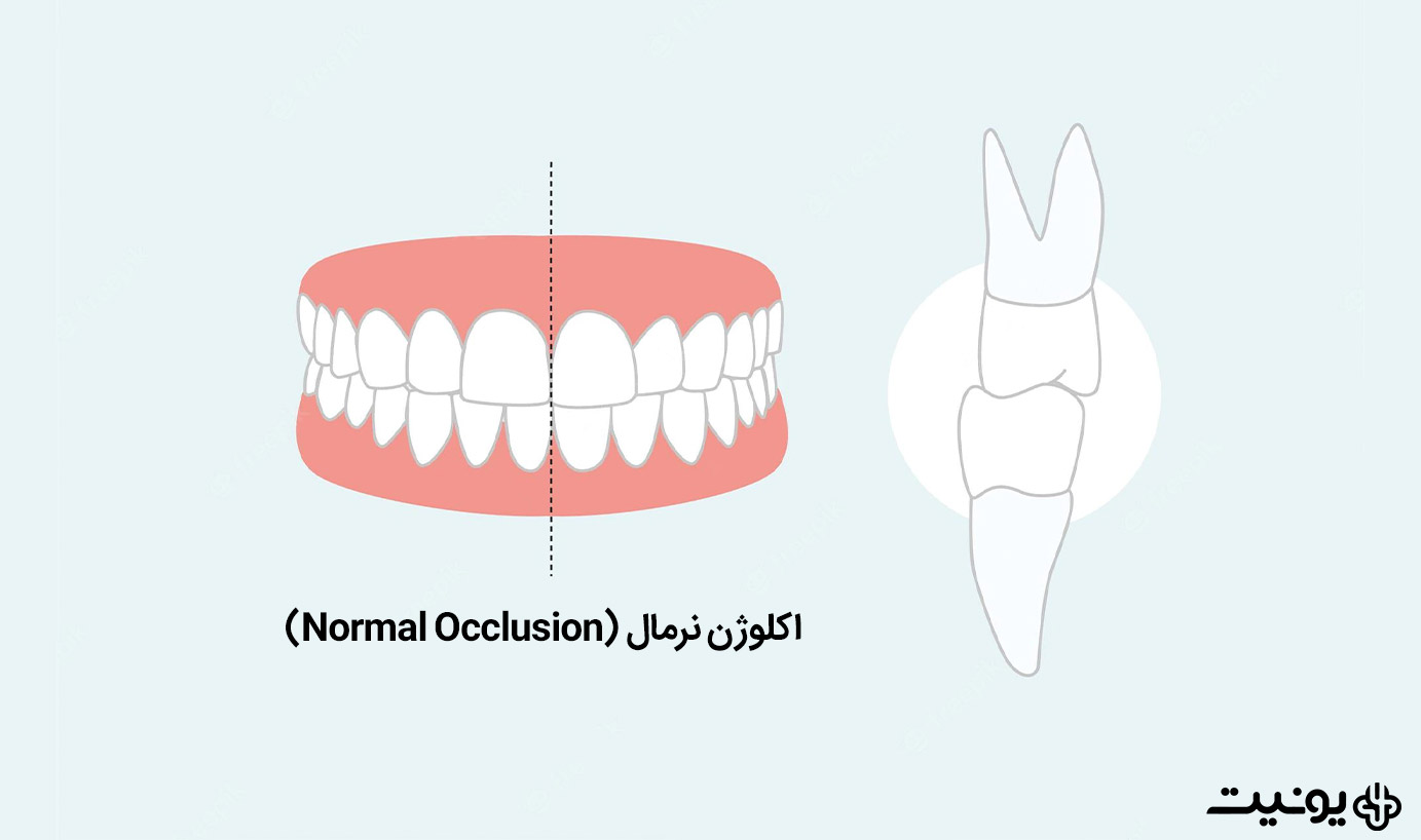 اکلوژن نرمال چیست؟