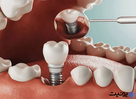 ایمپلنت دندان چیست