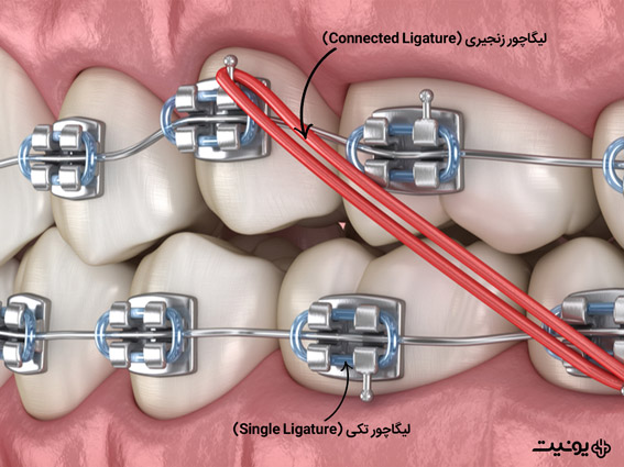 انواع مختلف لیگاچور ارتودنسی