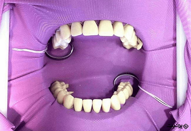 رابردم دندانپزشکی چیست
