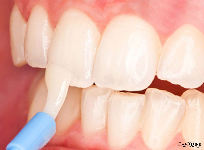 وارنیش فلوراید به عنوان سفیدکننده دندان