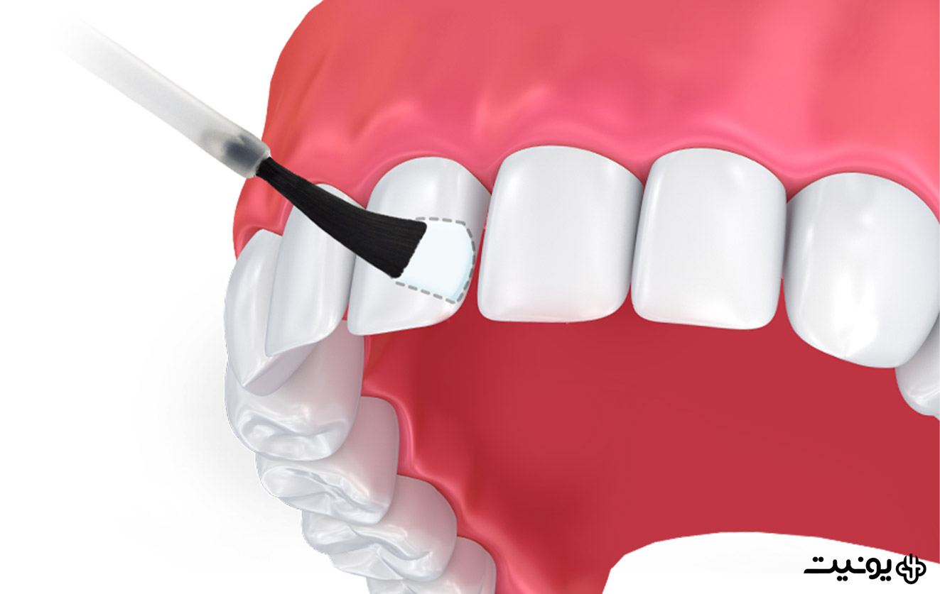 فلورتید تراپی یا وارنیش دندان چیست