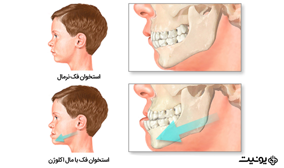 تفاوت فک نرمال و مال اکلوژن