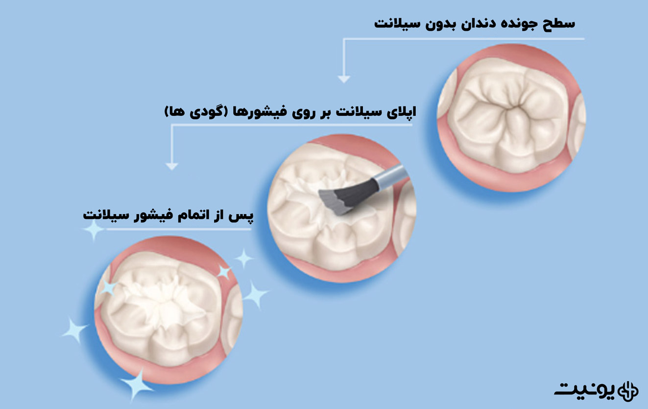فیشور سیلانت دندان مولر (Molar)