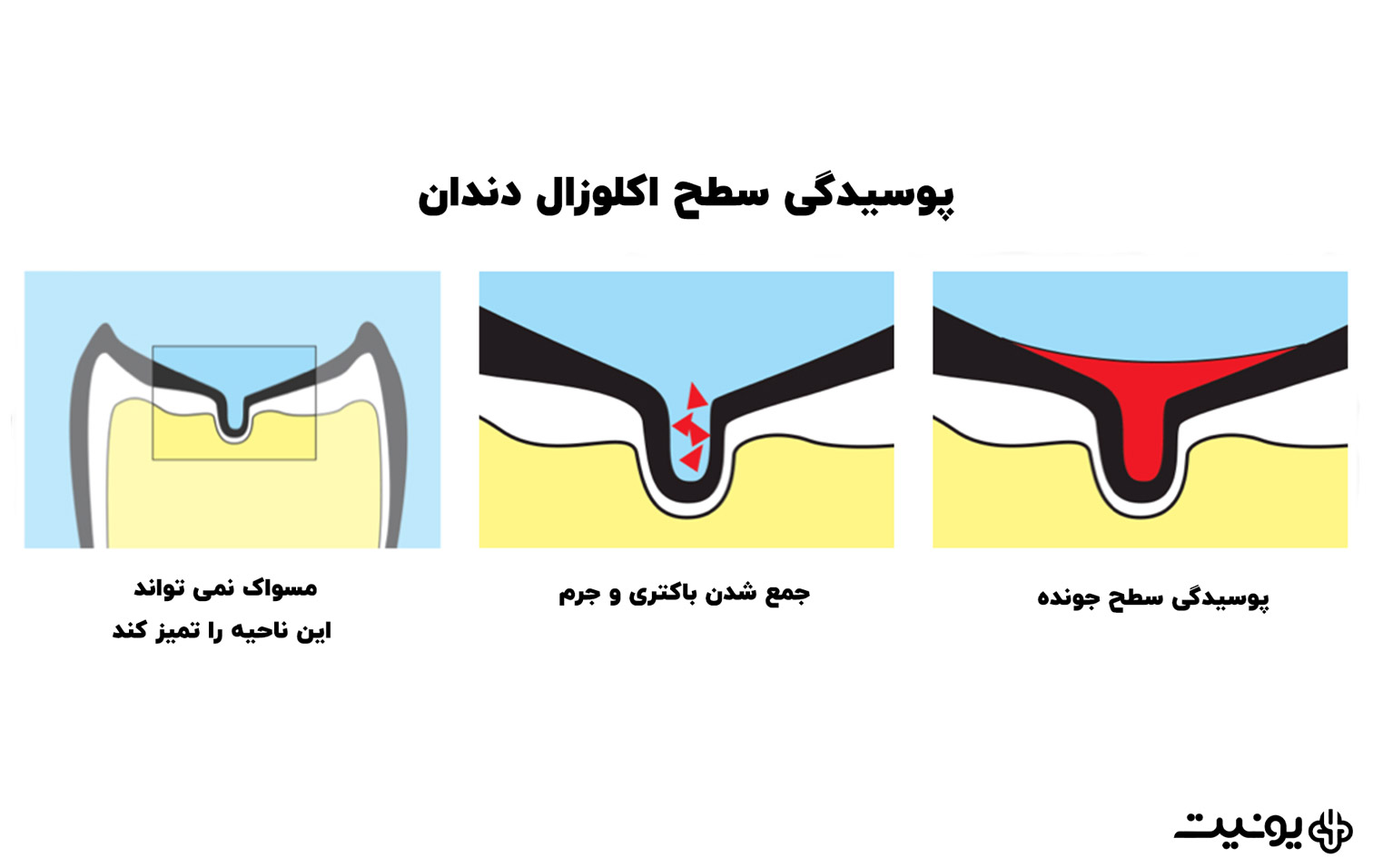 پوسیدگی سطح اکلوزال دندان 