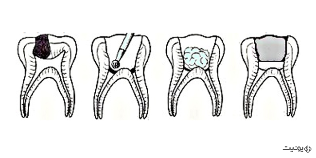 فرایند پرفوریشن چیست؟