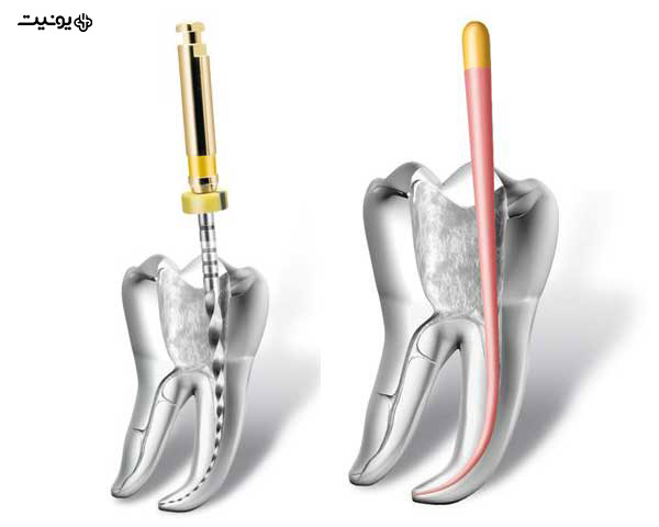 درمان کانال ریشه دندان 