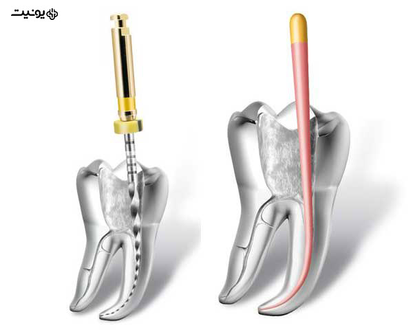 درمان کانال ریشه یا روت کانال تراپی