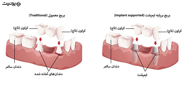 تفاوت انواع بریج