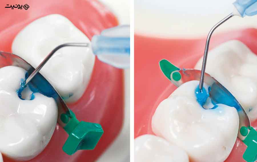 کاربرد اسید اچ دندانپزشکی