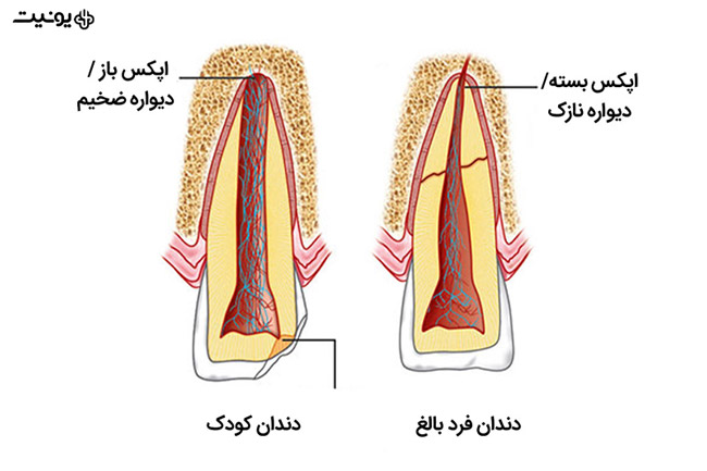 تفاوت اپکس باز و بسته