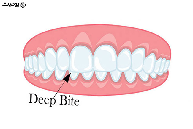 مشکل دیپ بایت دندان