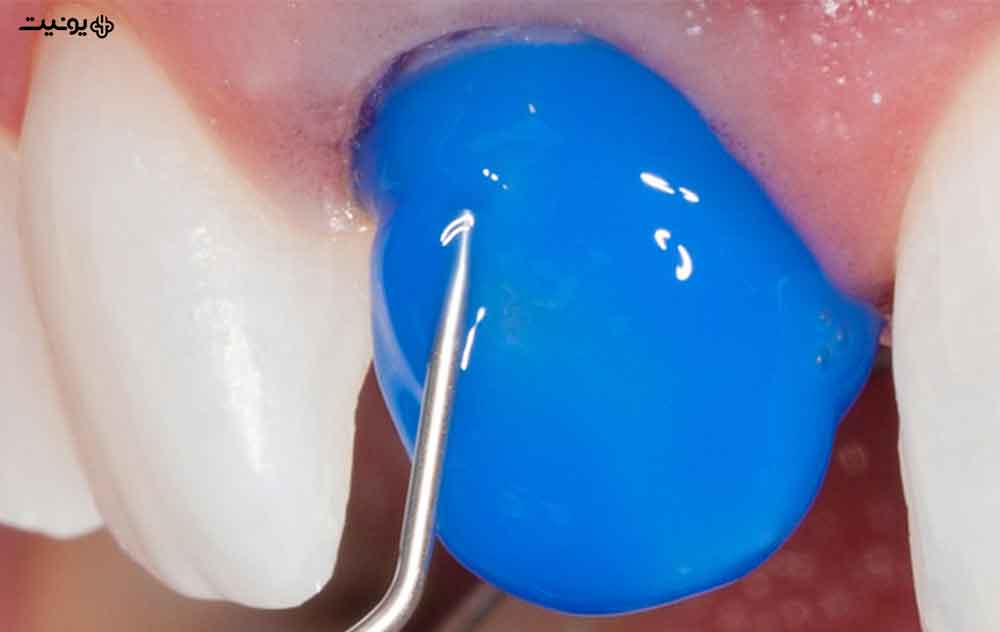 اسید اچ دندانپزشکی چیست