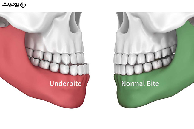 انواع بایت های دندانی