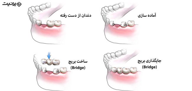 بریج دندانی چیست؟