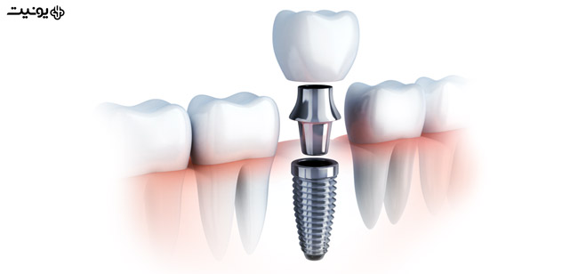 روش های انجام ایمپلنت دندانی