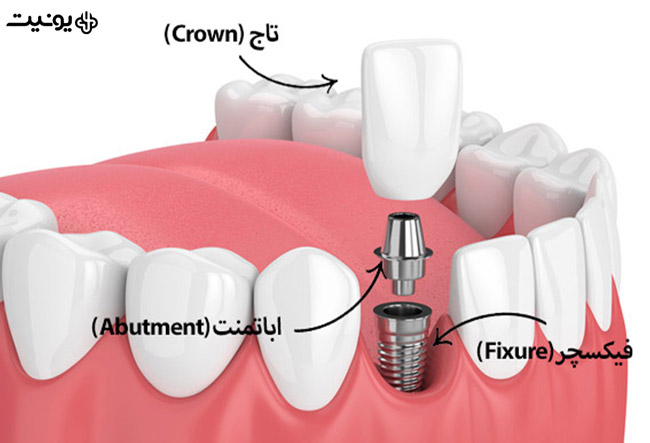 ایمپلنت دندان چیست؟