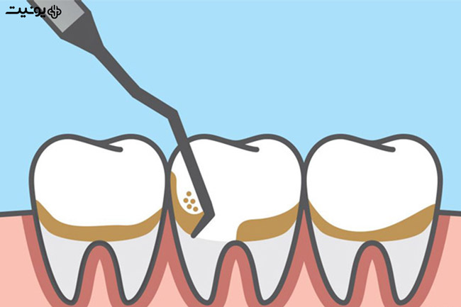 جرمگیری دندان چیست؟