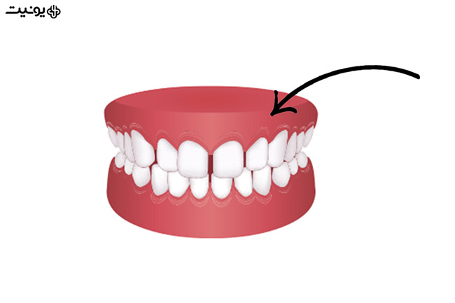 فاصله بین دندانی