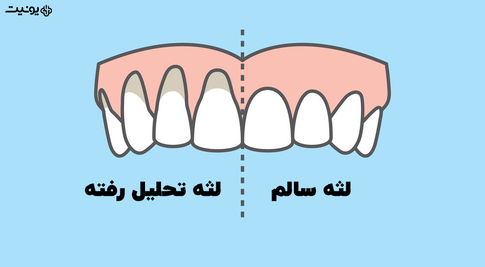 تحلیل لثه چیست