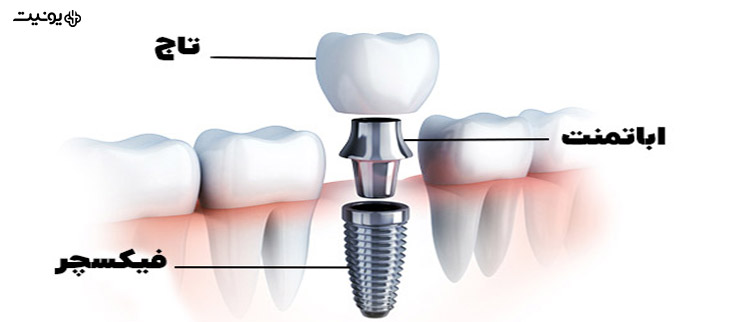 اباتمنت دندان چیست
