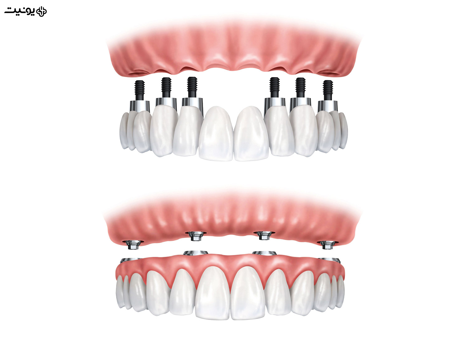 فرق اوردنچر و ایمپلنت دندان