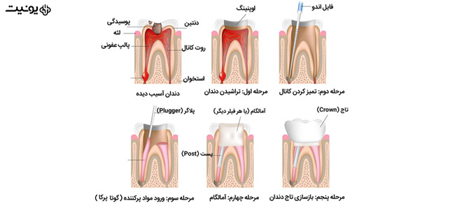 روت کانال چیست؟