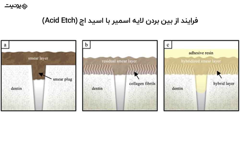 لایه اسمیر دندان چیست