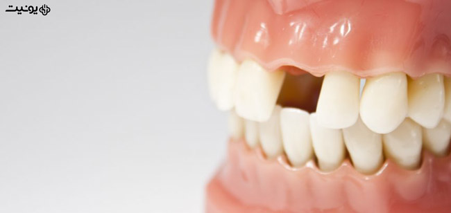 چه موقع پروتز دندان انجام دهیم؟