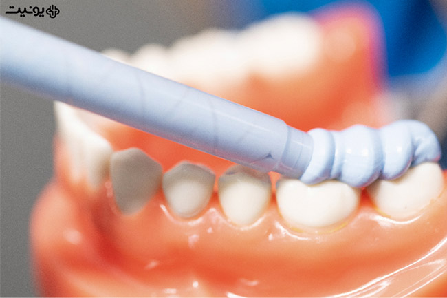 روش های قالبگیری از دندان