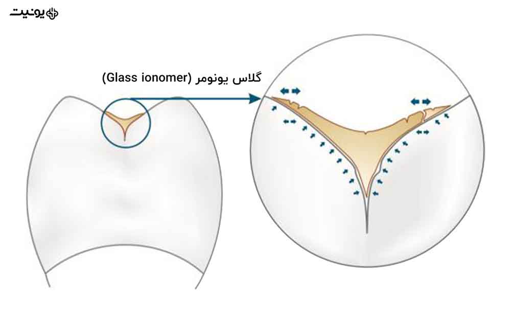 گلاس آینومر چیست؟