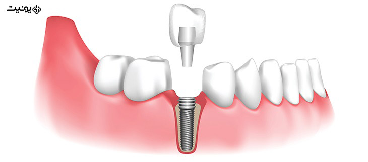 ایمپلنت دندانی