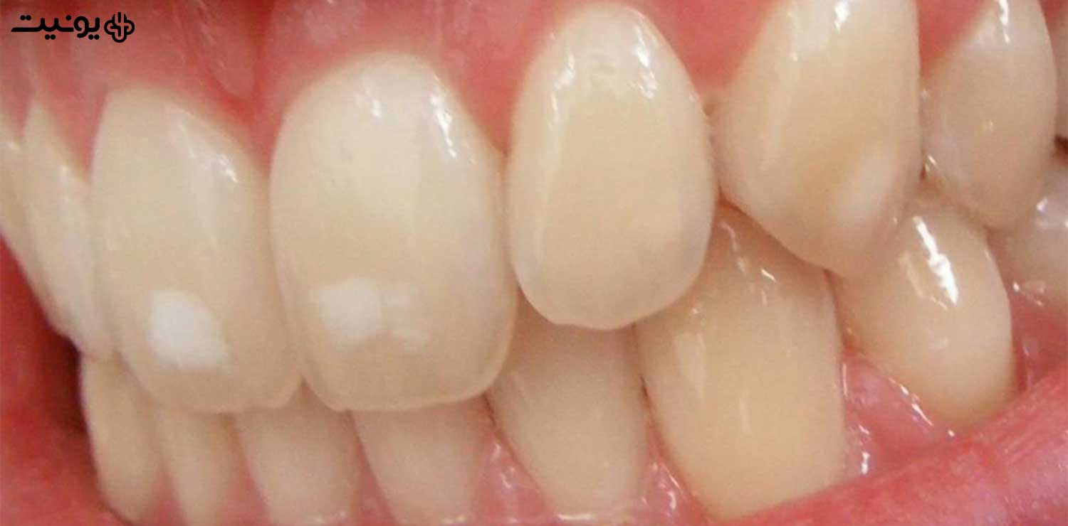 از بین بردن لکه های سفید دندان با لیزر
