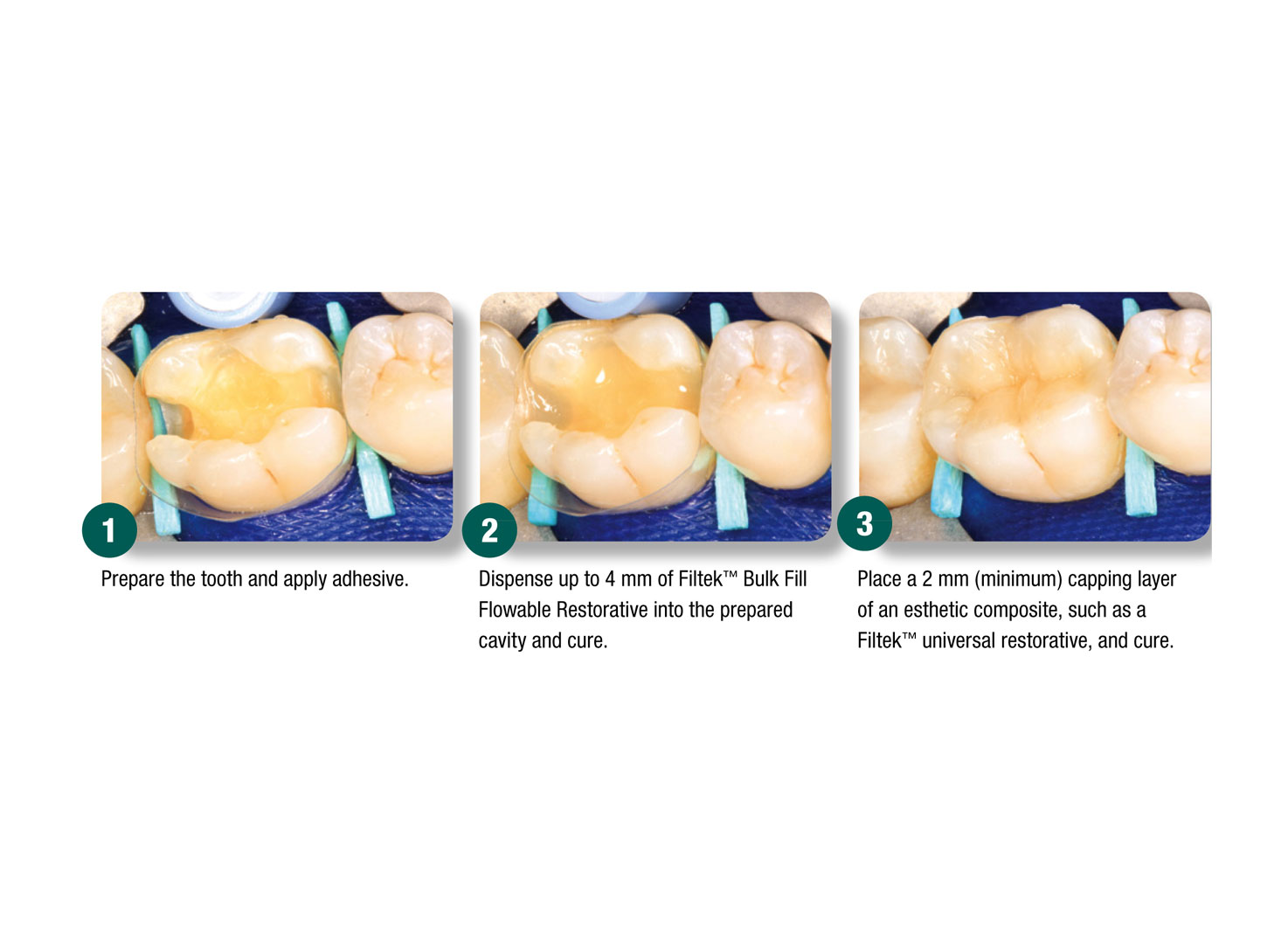 کامپوزیت خلفی بالک فیل Filtek Bulk Fill سرنگ 4 گرمی برند 3M