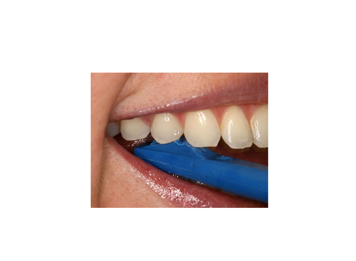 ابزار تشخیص پوسیدگی دندان FranFinder برند Directa