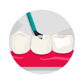 فیشور سیلانت یا شیاربندی دندان چه کاربردی دارد؟