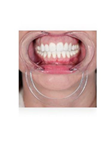 |دهان بازکن خارج دهانی برند OrthoTechnology