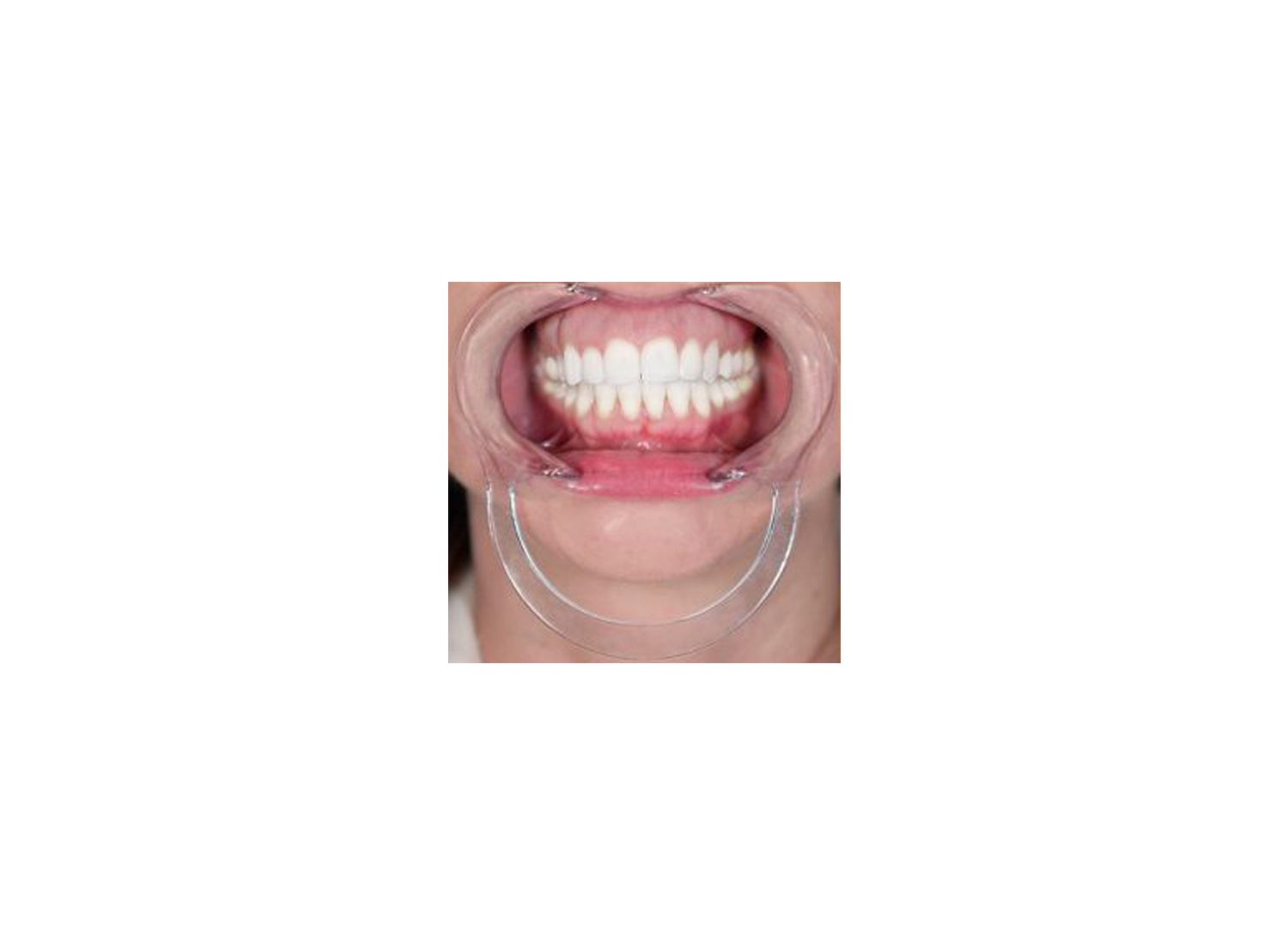 دهان بازکن خارج دهانی برند OrthoTechnology