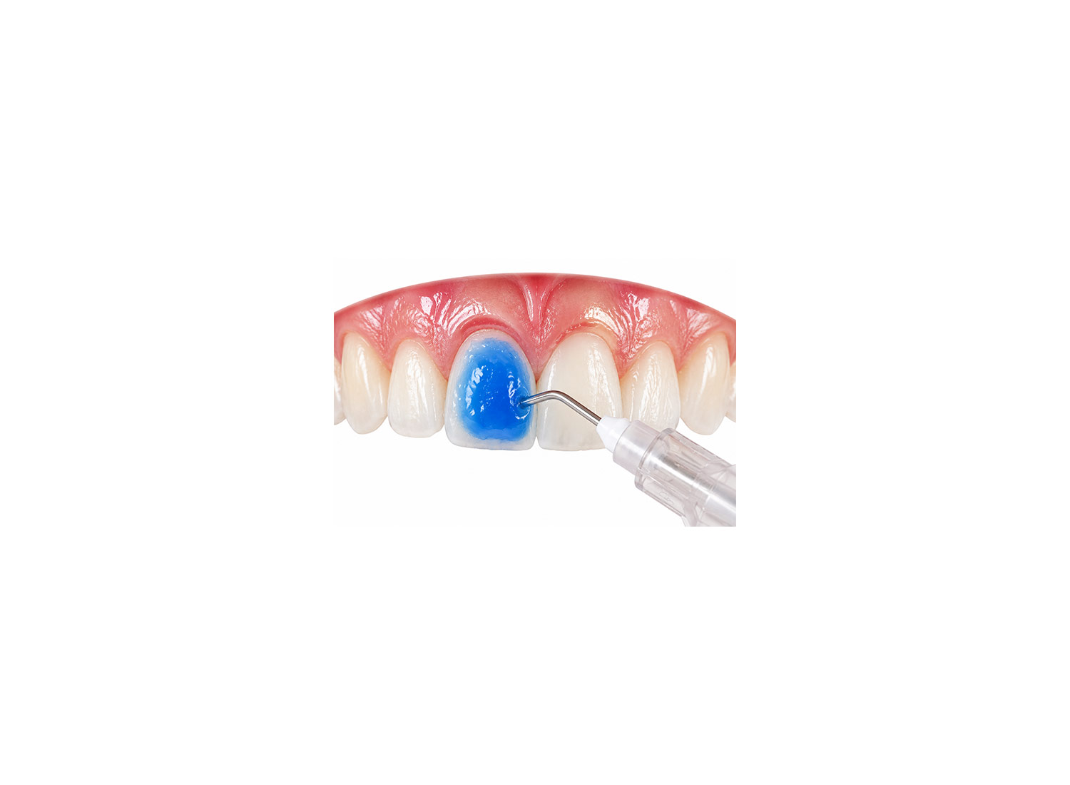 سری ژل اسید اچ بسته 30 عددی برند Kerr Dental