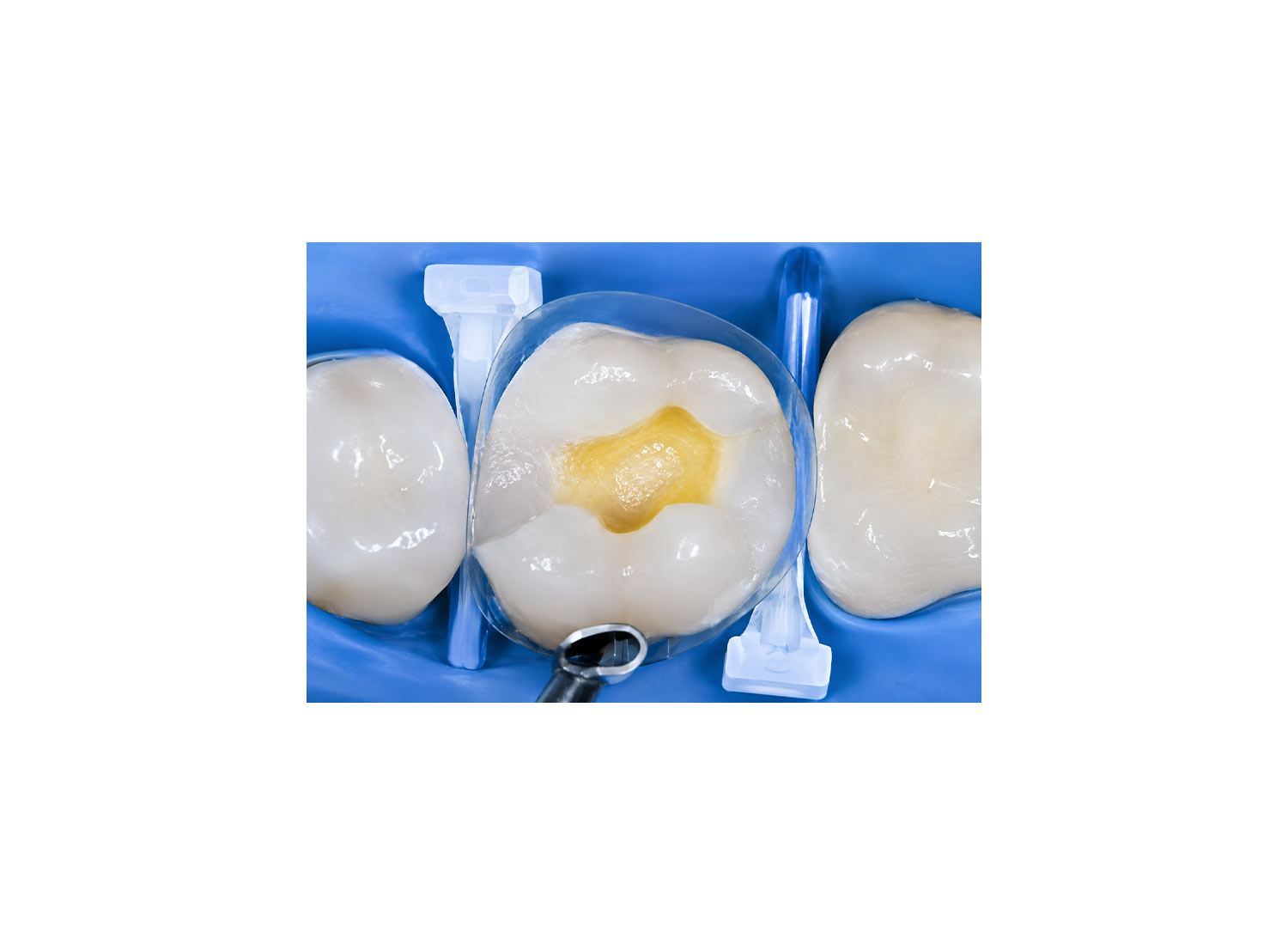 وج لایت آسورت مدل Luciwedges Classic برند Kerr Dental