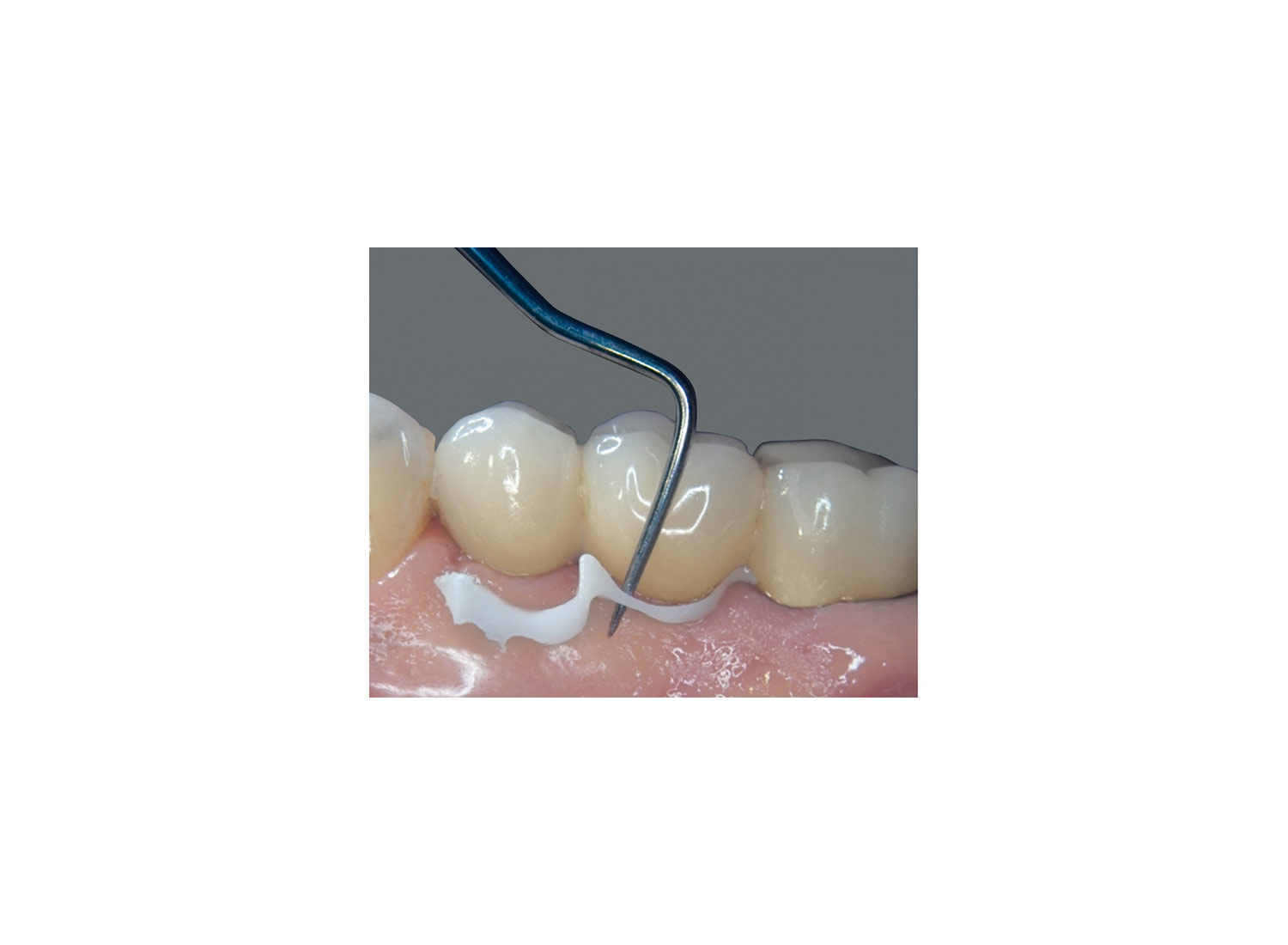 سمان رزینی نیمه موقت ایمپلنت implantlink برند DETAX