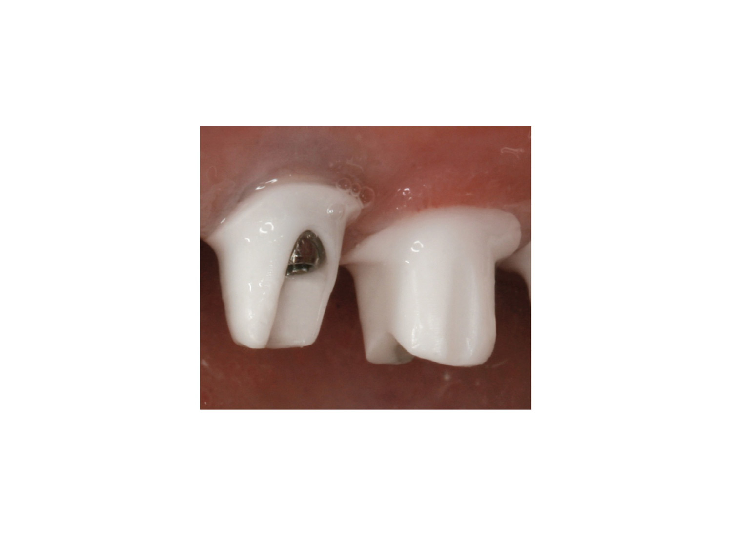 سمان رزینی نیمه موقت ایمپلنت implantlink برند DETAX